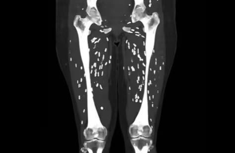 Read more about the article Doctors Shocked by CT Scan Showing Legs Infested with Tapeworms After Eating Undercooked Pork