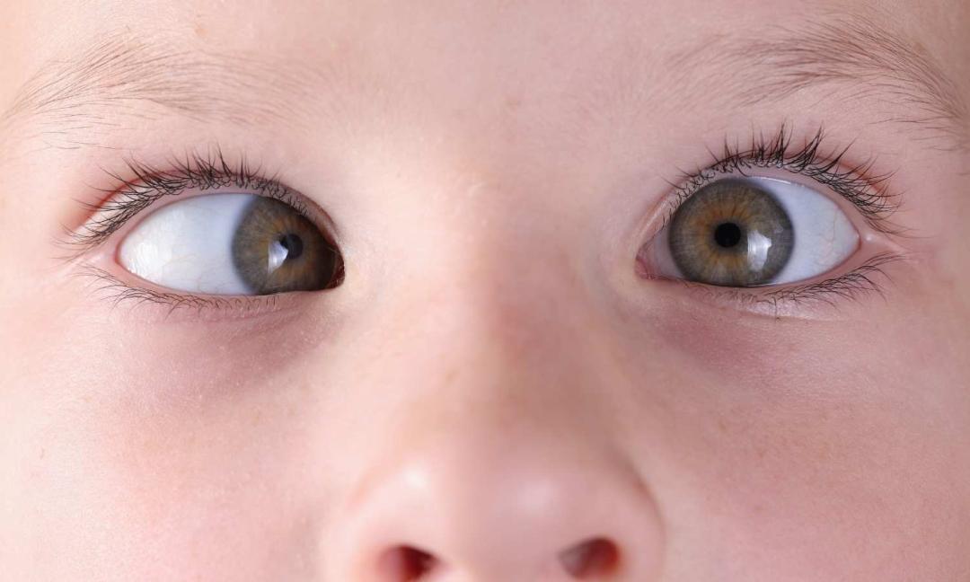 You are currently viewing Don’t Ignore Your Child’s Squinting – 6 Possible Reasons Revealed!